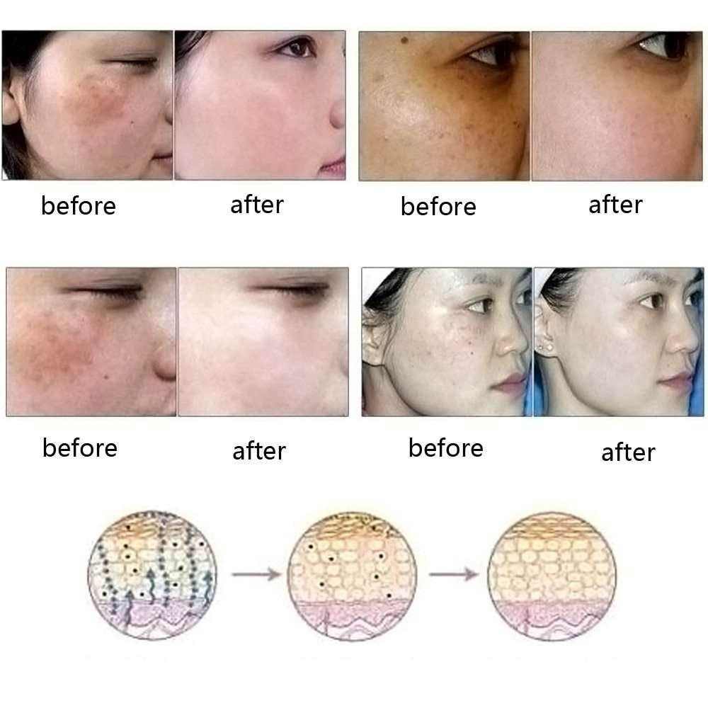 Dredge Meridian Acne Scar Removal Oil - Skin Regeneration Essence