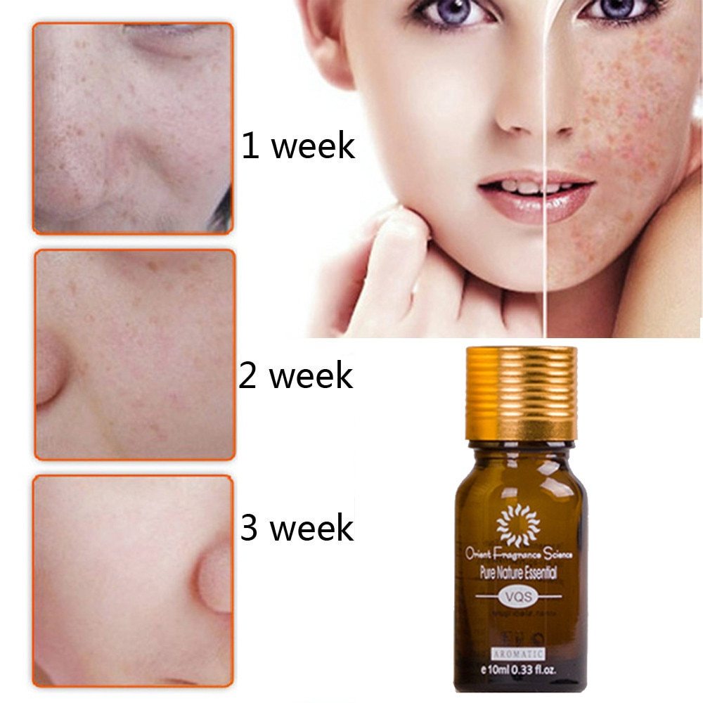 Natural pure removal acne stretch scar removal essence oil in bottle with before and after skin transformation images